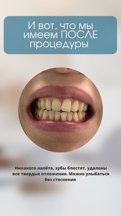 Профессиональная чистка зубов