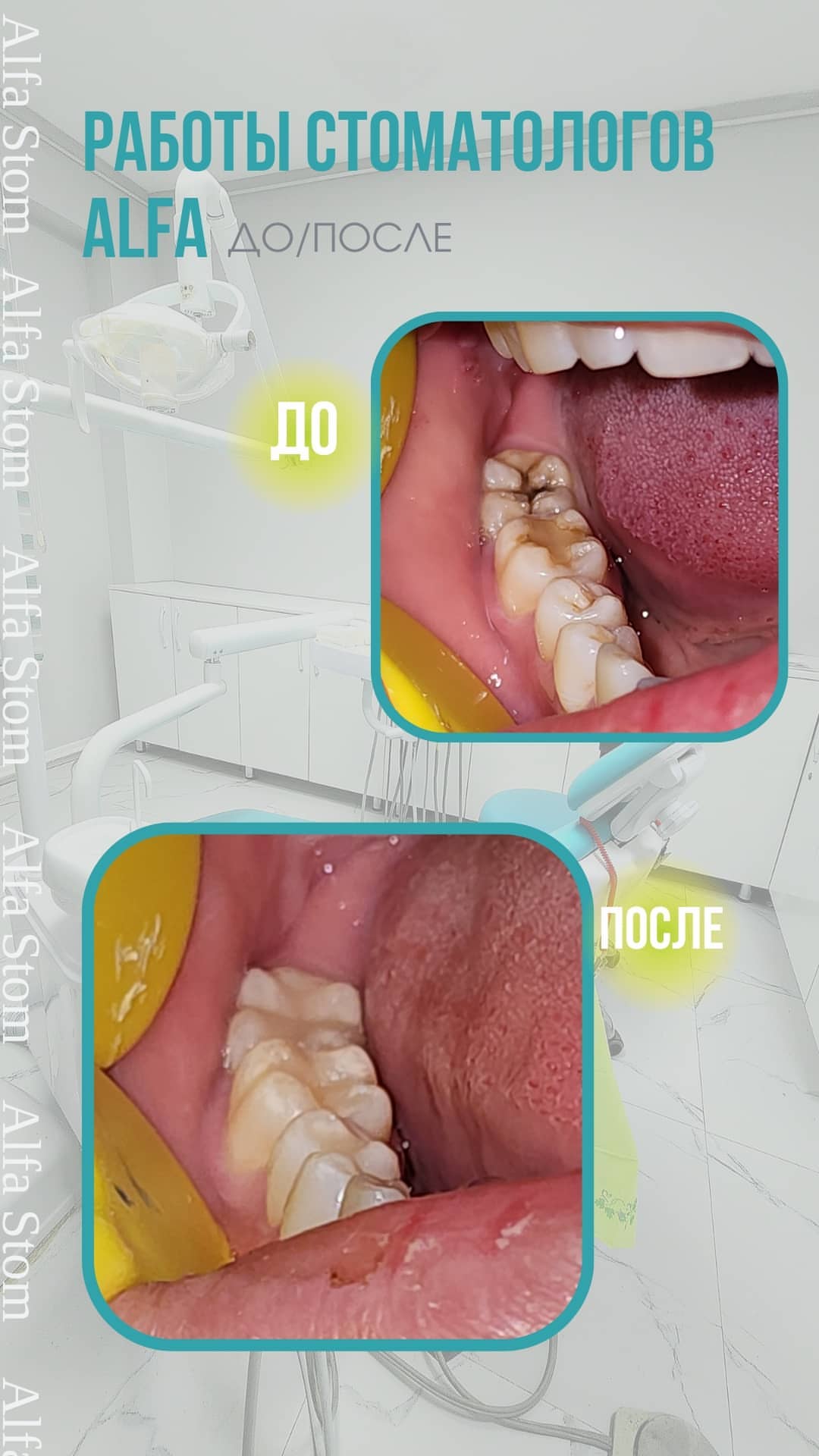 Герметизация фиссур