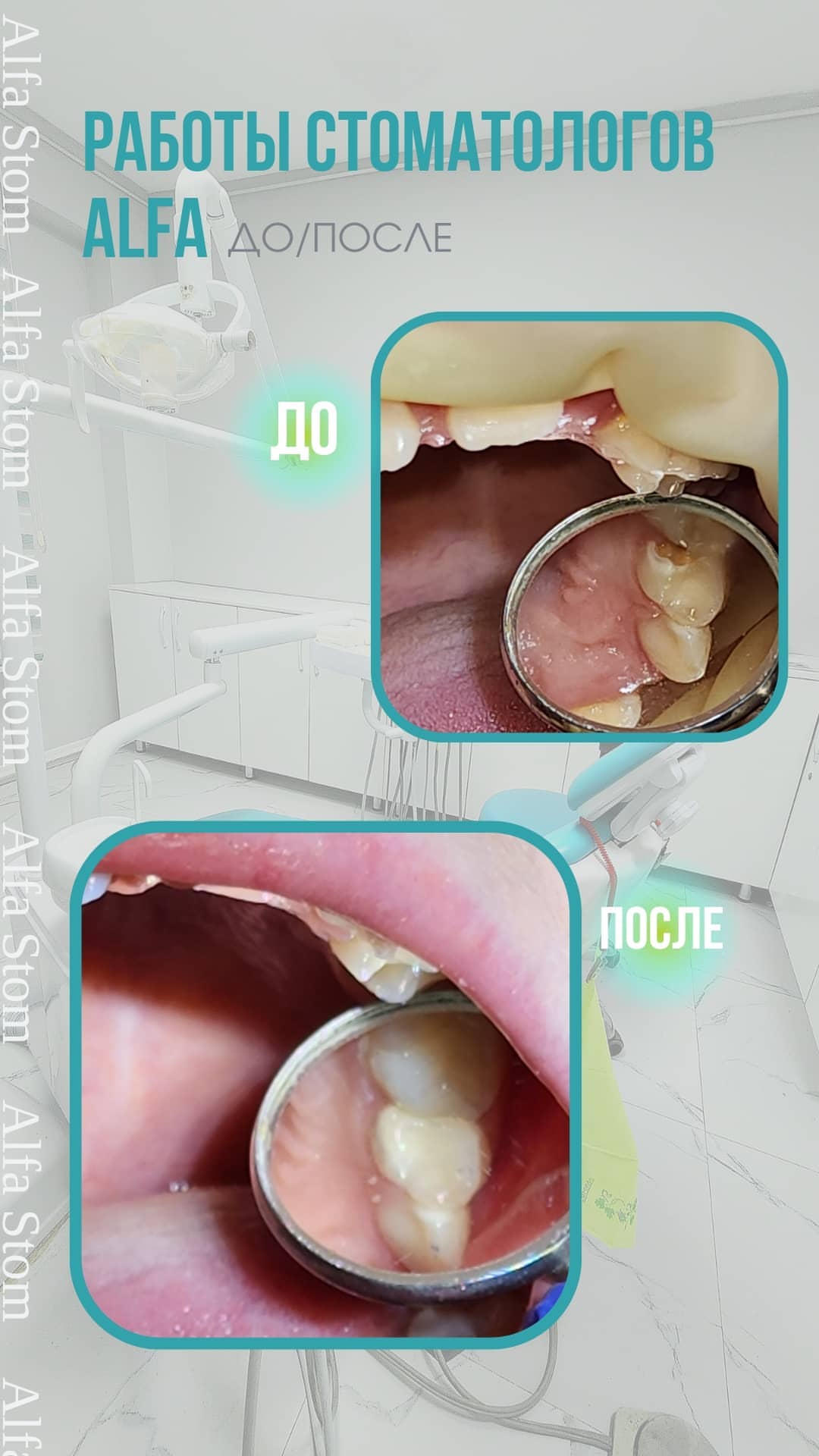 Наращивание зуба