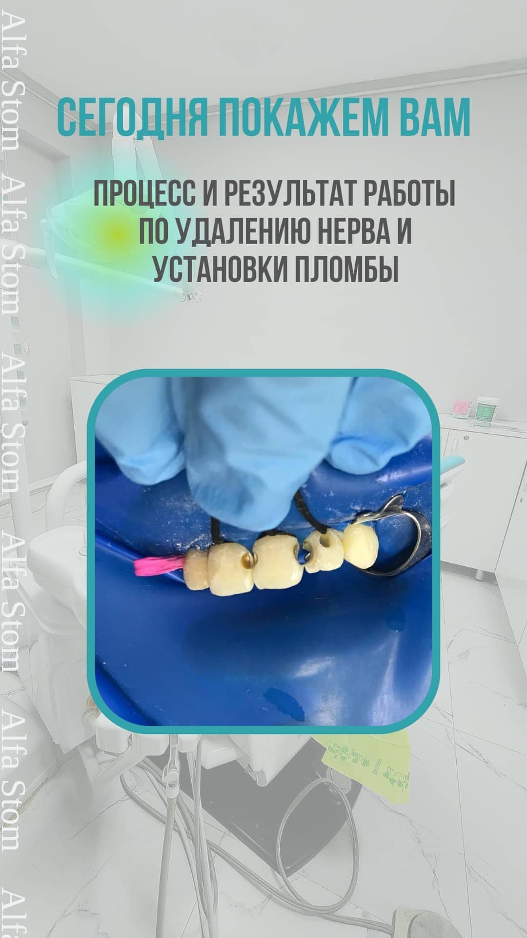 ДО/ПОСЛЕ — коронки