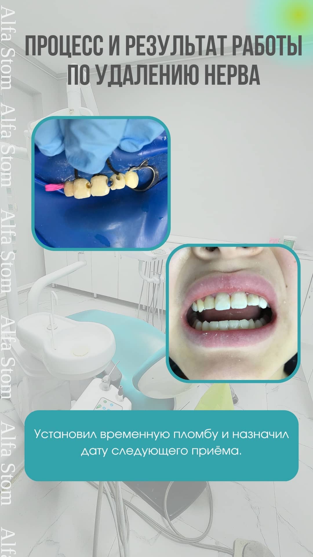 ДО/ПОСЛЕ — ортодонтия